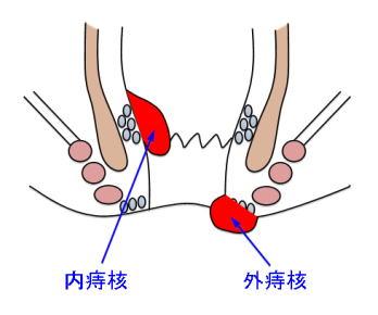 内痔核
