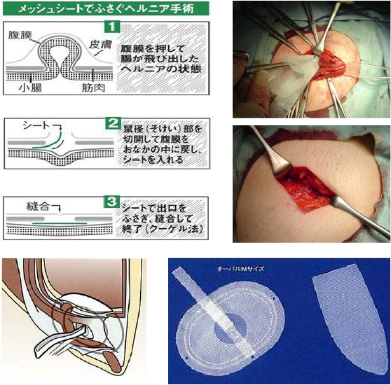 メッシュシートでふさぐヘルニア手術の画像や実際の手術写真