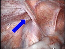 左外ソケイヘルニアの腹腔鏡から見た様子