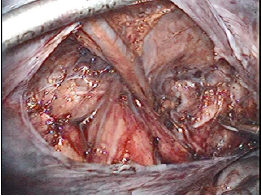 腹膜を切離し、膀胱前腔まで剥離した状態