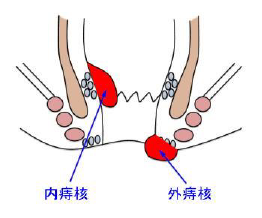 痔核のイラスト