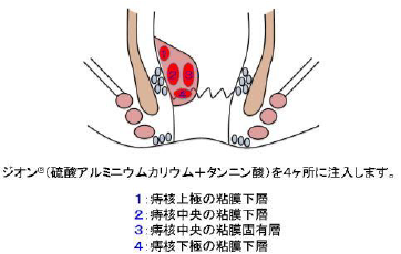 ＡＬＴＡ療法のイラスト