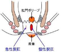 裂肛(きれ痔)のイラスト