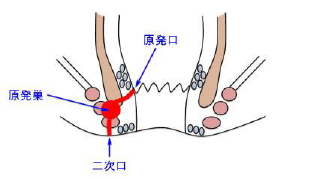 痔瘻(あな痔)のイラスト