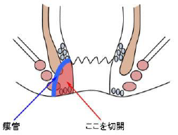 開放術式のイラスト