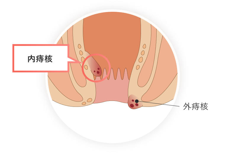 (図1)肛門の内側にできる痔核(いぼ痔)