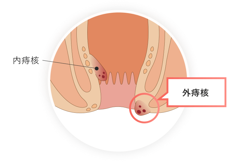肛門の外側にできる痔核