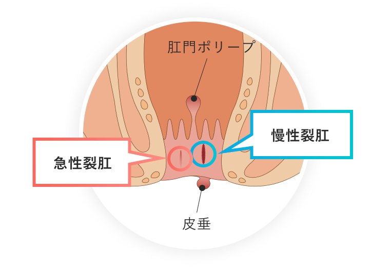 急性裂肛と慢性裂肛