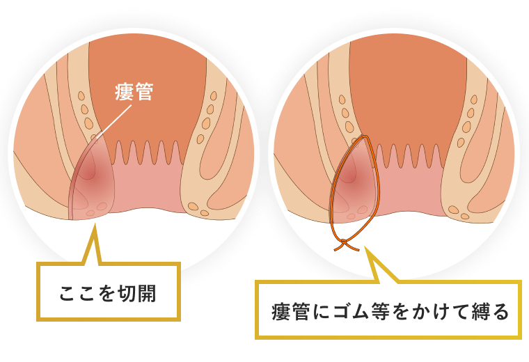 痔瘻の手術