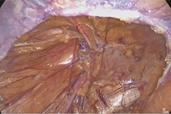 腹膜切離