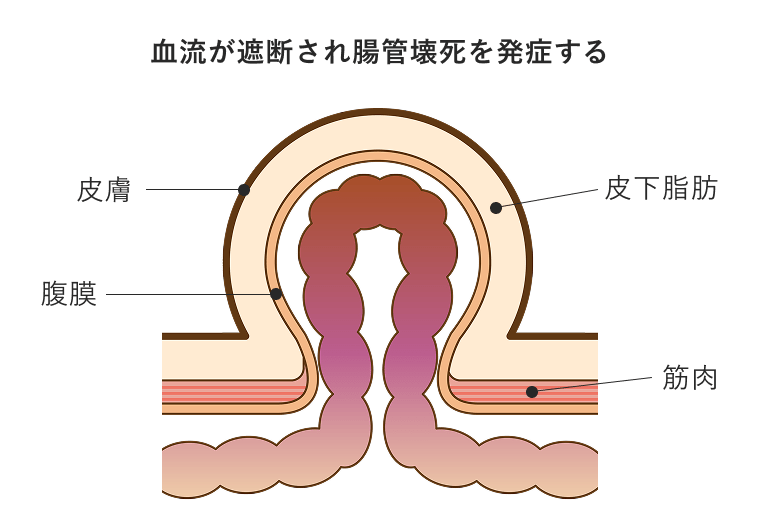 ヘルニアの嵌頓