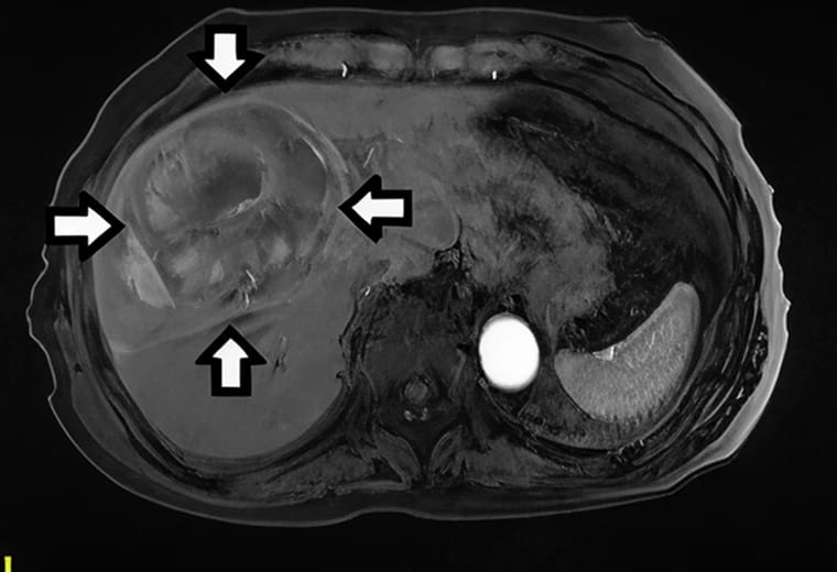 EOB-MRI