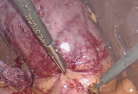 腹腔鏡下胆嚢摘出