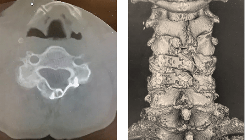頚椎椎弓形成術
