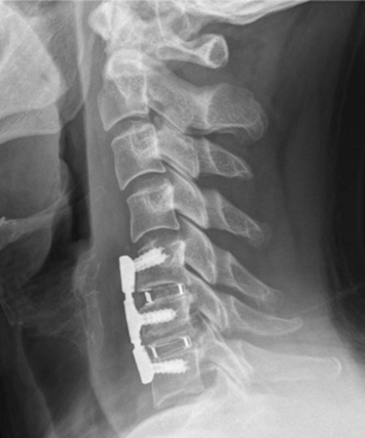 前方除圧固定術