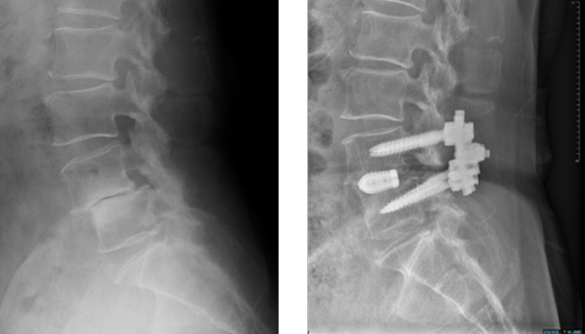 後方除圧固定術（PLIF／TLIF）