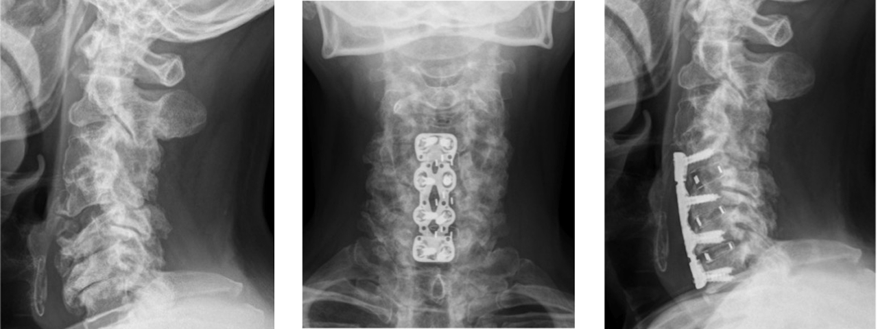 前方除圧固定術