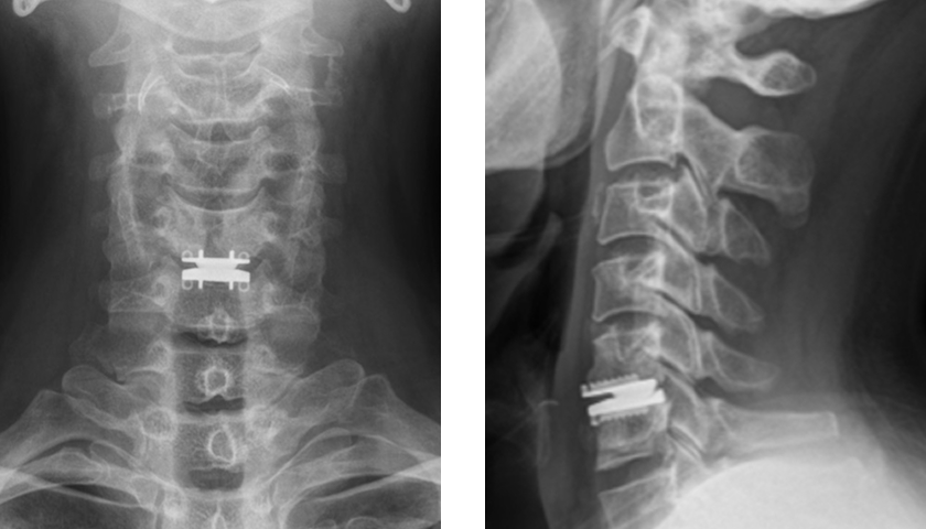 人工椎間板置換術