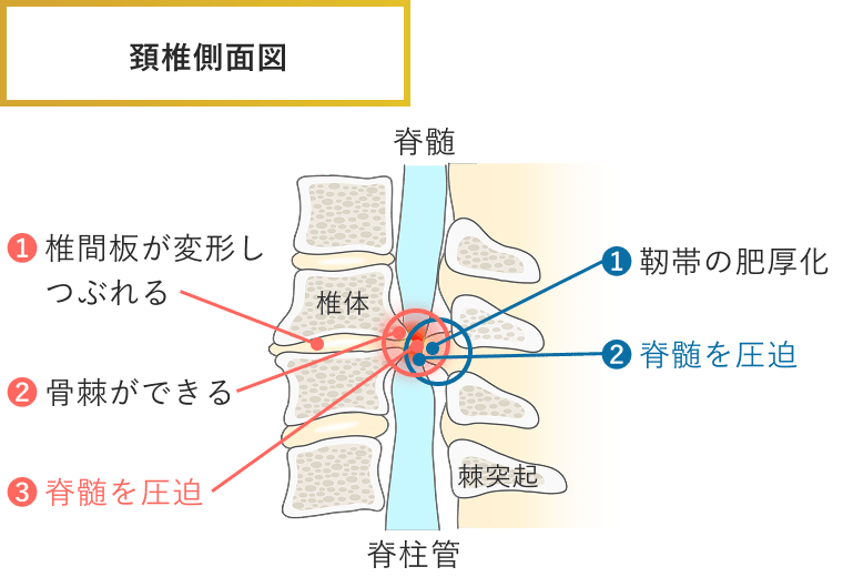 頚髄症（けいずいしょう）