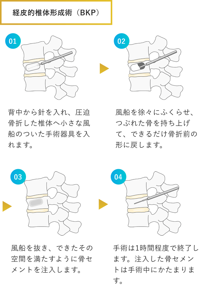 経皮的椎体形成術（BKP）