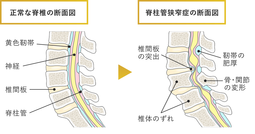 腰部脊柱管狭窄症