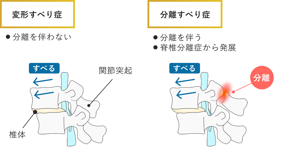 腰椎変性すべり症・腰椎分離すべり症
