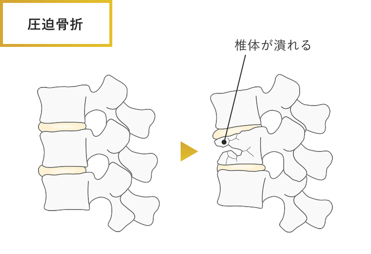 腰椎椎体骨折（圧迫骨折）